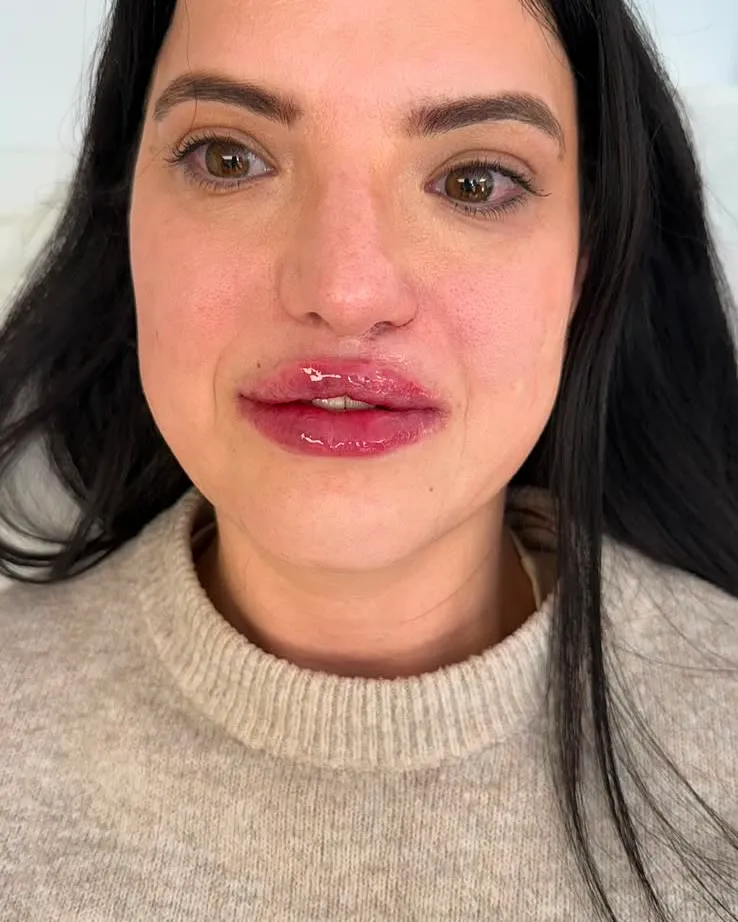 A CleftInject client after her treatment
